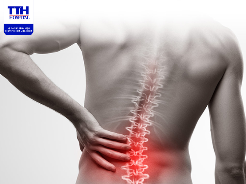 Thoát vị đĩa đệm cột sống thắt lưng: Nguyên nhân, triệu chứng và cách điều trị